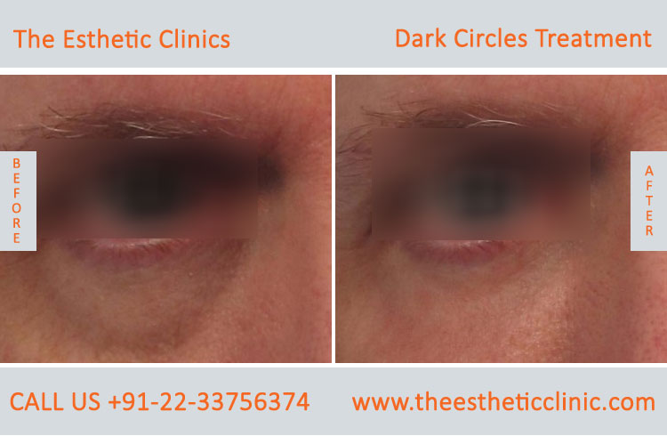 Under Eye Dark Circle Removal Laser Treatment before after photos in mumbai india (1)